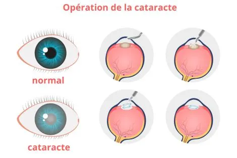 Schéma illustrant les étapes d'une opération de la cataracte : ablation du cristallin opacifié et remplacement par un cristallin artificiel.