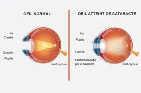 Schéma comparant un œil normal et un œil atteint de cataracte, avec les différentes parties identifiées