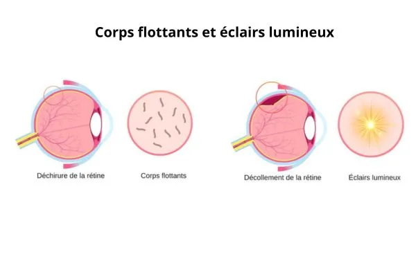 illustration une déchirure de la rétine qui entraîne
l'apparition de corps flottants dans le champ de vision et un décollement de la rétine provoquant la perception d'éclairs lumineux