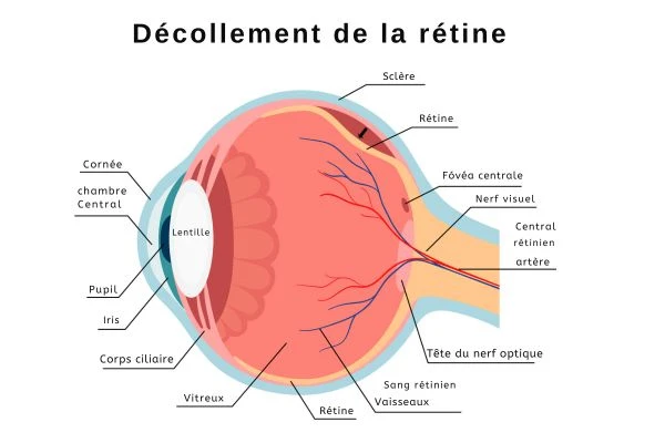 illustration de l'oeil humain avec un decollement de la retine