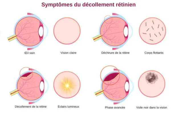 infographie présente de manière claire et progressive les symptômes du decollement de la retine