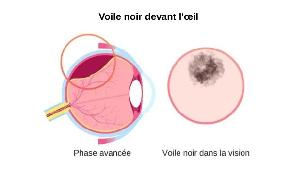 Décollement de la rétine a un stade avancé, obstruction de la vision par un voile noir