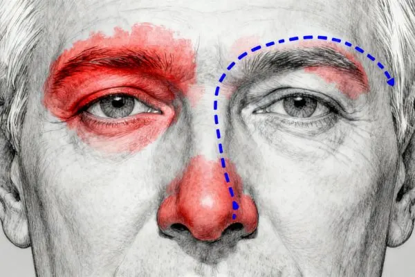 Schéma d’un visage montrant le trajet du nerf ophtalmique pour expliquer le zona ophtalmique chez les plus de 50 ans