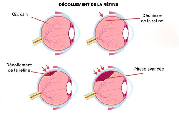Schéma du decollement de la retine de l'état sain à l'apparition d'une petite déchirure, à l'initiation du décollement et à une phase avancée