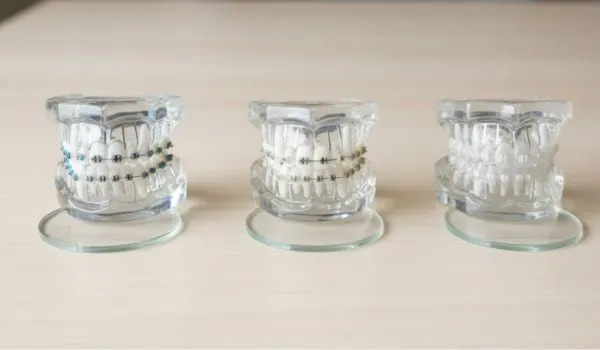 Comparaison visuelle des trois types d'appareils dentaires : bagues métal, céramique et aligneurs invisibles.
